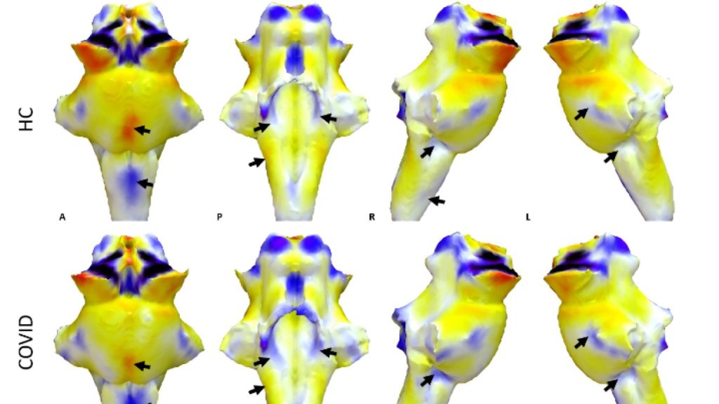 Η βλάβη στο εγκεφαλικό στέλεχος υπεύθυνη για τα συμπτώματα του μακροχρόνιου Covid